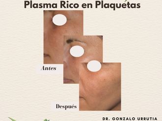 Plasma rico en plaquetas - 826374