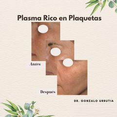 Plasma rico en plaquetas - Dr. Gonzalo Urrutia