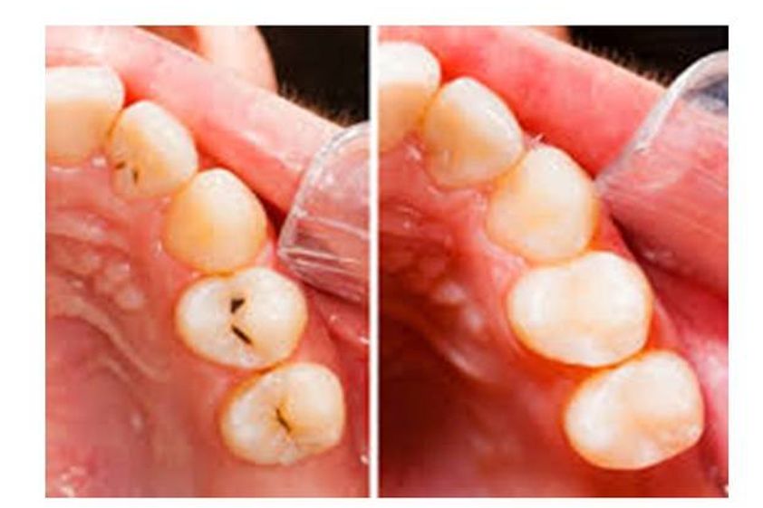Periodoncia antes y después - 545223