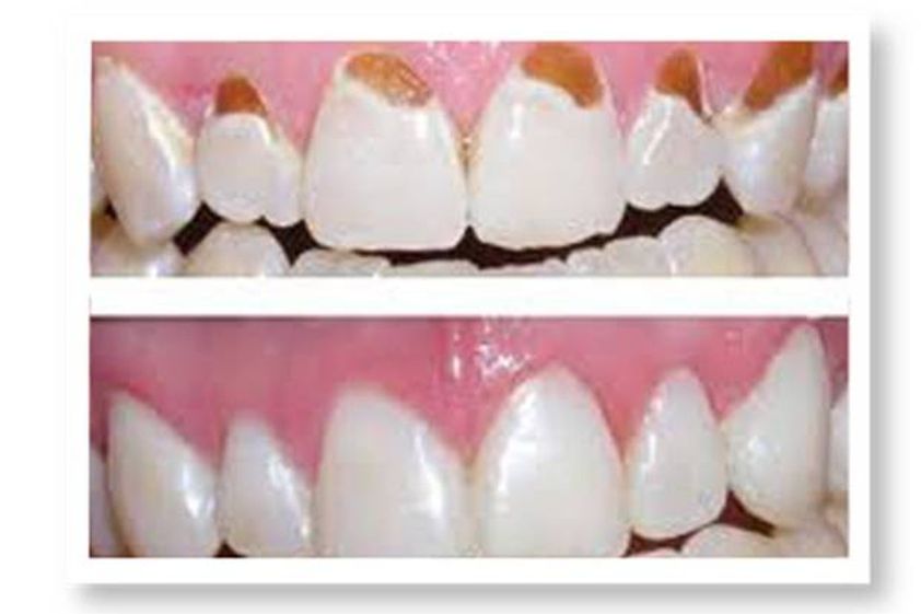 Periodoncia antes y después - 545225