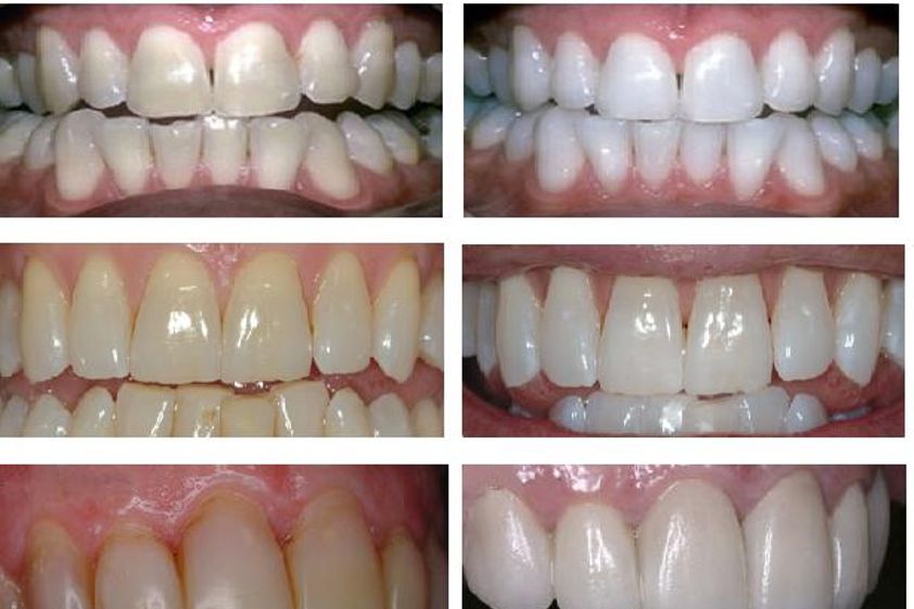 Blanquear dientes antes y después - 420753