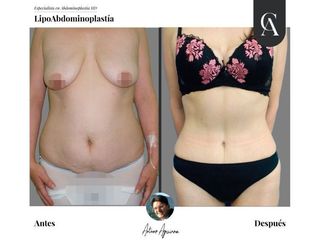 Lipoabdomindoplastia - Dr. Arturo Aguirre