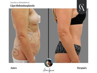 Lipoabdomindoplastia - Dr. Arturo Aguirre