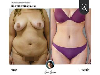 Lipoabdomindoplastia - Dr. Arturo Aguirre