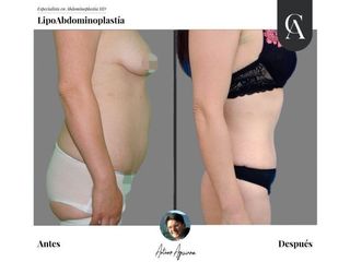 Lipoabdomindoplastia - Dr. Arturo Aguirre