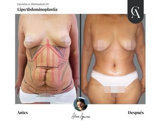 Lipoabdomindoplastia - Dr. Arturo Aguirre