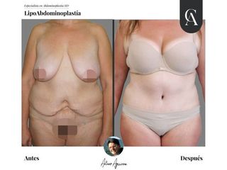 Lipoabdomindoplastia - Dr. Arturo Aguirre