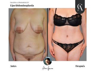 Lipoabdomindoplastia - Dr. Arturo Aguirre