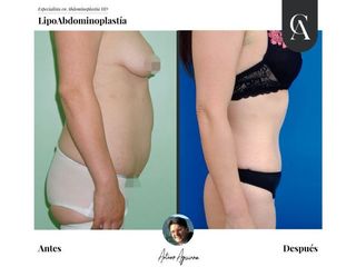 Lipoabdomindoplastia - Dr. Arturo Aguirre