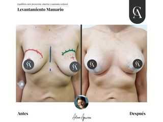 Aumento mamario - Dr. Arturo F Aguirre A