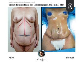 Lipoabdomindoplastia - Dr. Arturo F Aguirre A
