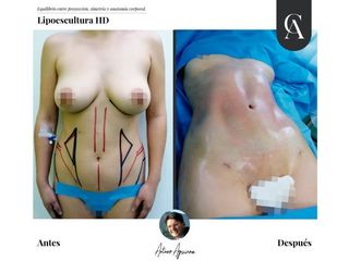 Lipoescultura HD - Dr. Arturo F Aguirre A