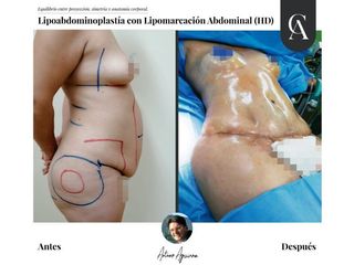 Lipoabdomindoplastia - Dr. Arturo F Aguirre A