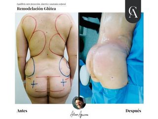 Aumento glúteos - Dr. Arturo F Aguirre A