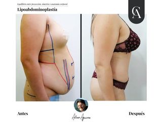 Lipoabdomindoplastia - Dr. Arturo F Aguirre A