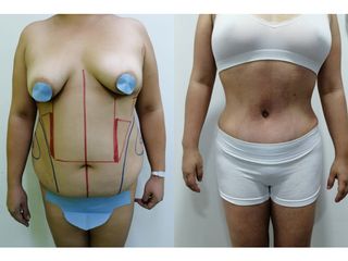 Abdominoplastia - Dr. Arturo F Aguirre A