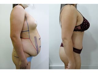 Abdominoplastia - Dr. Arturo F Aguirre A
