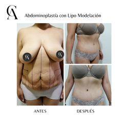 Abdominoplastía con Lipomodelación - Dr. Arturo F Aguirre A