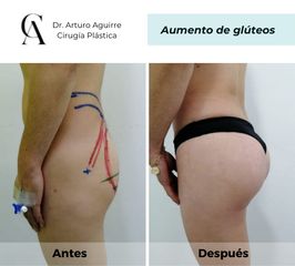 Aumento de glúteos - Dr. Arturo F Aguirre A