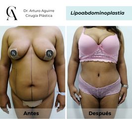 Lipoabdomindoplastia - Dr. Arturo F Aguirre A