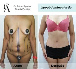 Lipoabdomindoplastia - Dr. Arturo F Aguirre A