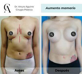 Aumento mamario - Dr. Arturo F Aguirre A