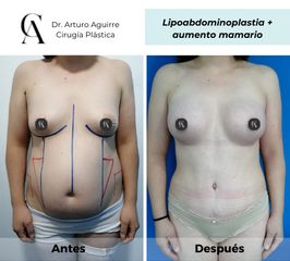 Lipoabdomindoplastia - Dr. Arturo F Aguirre A