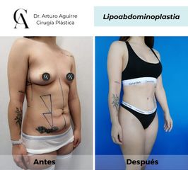 Lipoabdomindoplastia - Dr. Arturo F Aguirre A