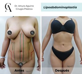 Lipoabdomindoplastia - Dr. Arturo F Aguirre A