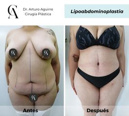 Lipoabdomindoplastia - Dr. Arturo F Aguirre A