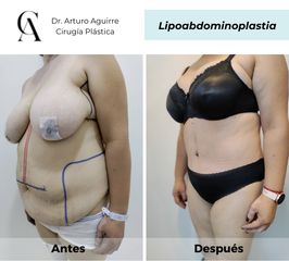 Lipoabdomindoplastia - Dr. Arturo F Aguirre A