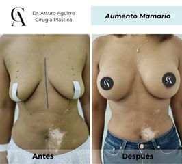 Aumento mamario - Dr. Arturo F Aguirre A