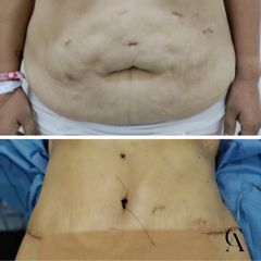 Abdominoplastia - Dr. Arturo F Aguirre A