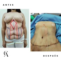 Abdominoplastia - Dr. Arturo F Aguirre A