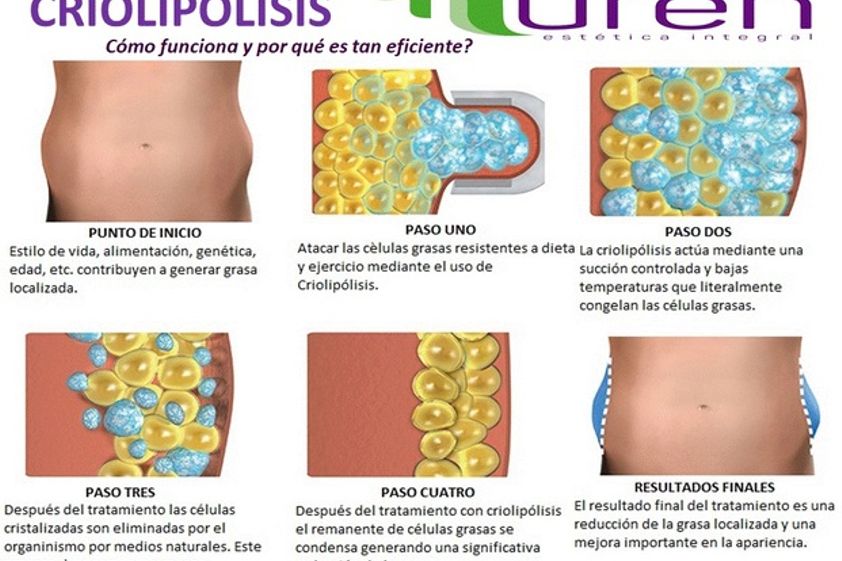 Criolipólisis antes y después - 613647