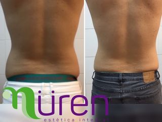 Criolipolisis Hombres y Mujeres