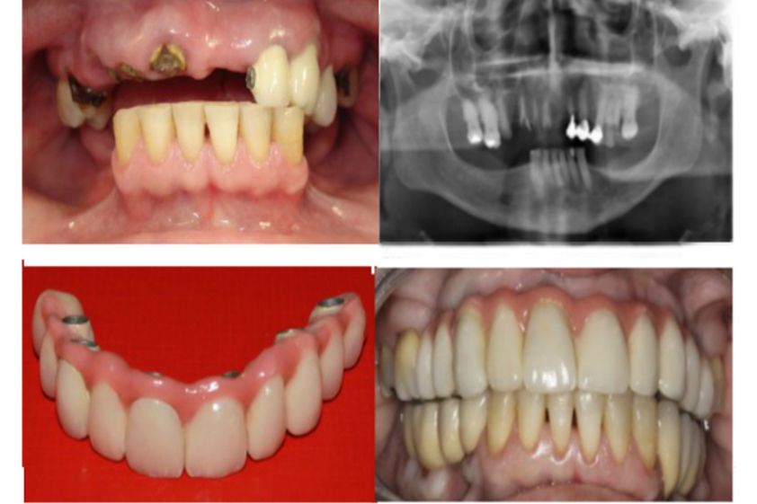 Prótesis dentales antes y después - 501739