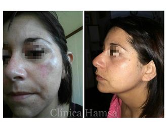 Plasma rico en plaquetas - 630711