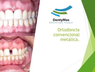 Ortodoncia invisible - 645413