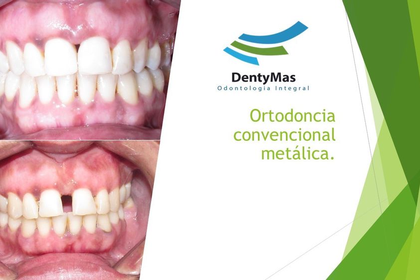 Ortodoncia invisible antes y después - 645413