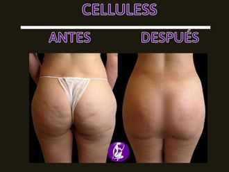 Tratamiento celulitis antes y después - 848968