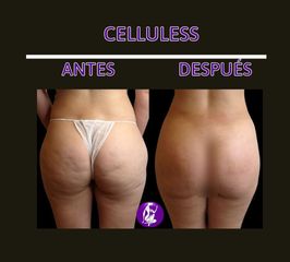 Tratamiento celulitis - Centro Cince
