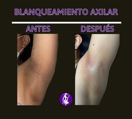 Blanqueamiento axilar - Centro Cince