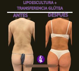 Aumento glúteos - Centro Cince