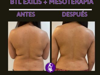 Mesoterapia antes y después - 848972