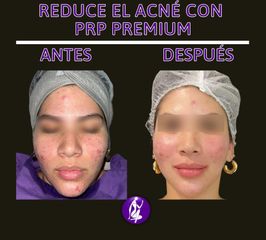 Traitement acné - Centro Cince