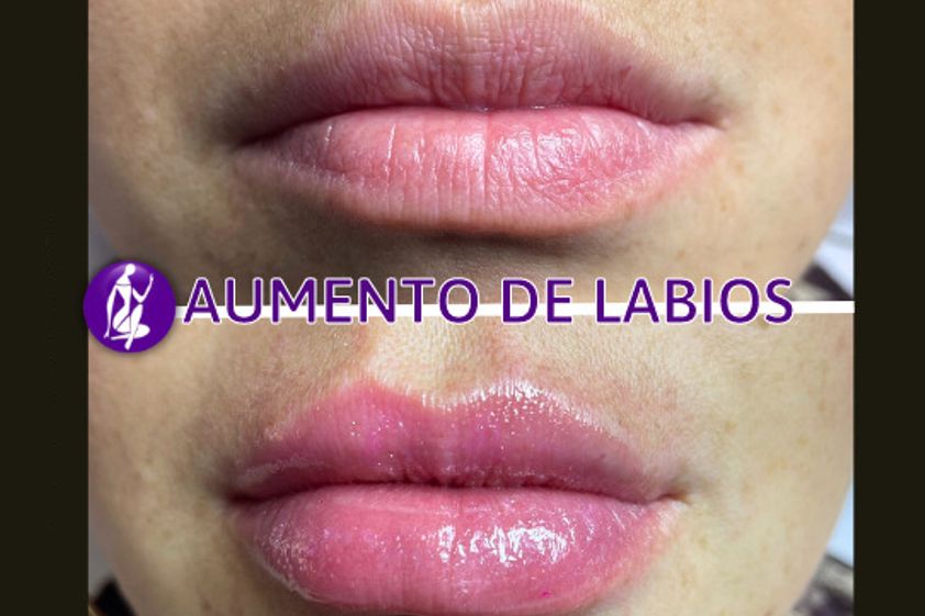 Aumento de labios antes y después - 848974