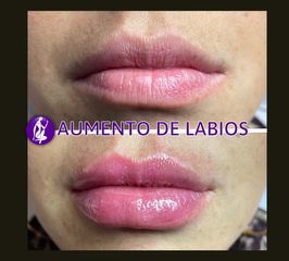 Aumento de labios - Centro Cince