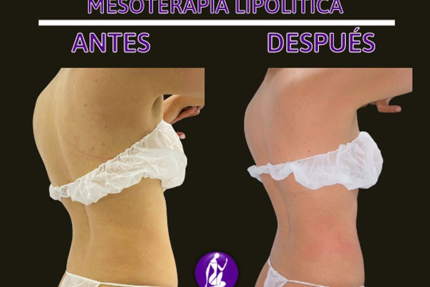 Mesoterapia antes y después - 848976