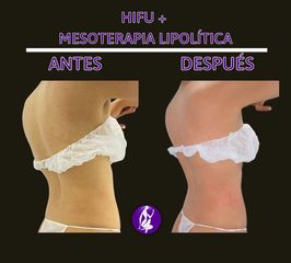 Mesoterapia - Centro Cince